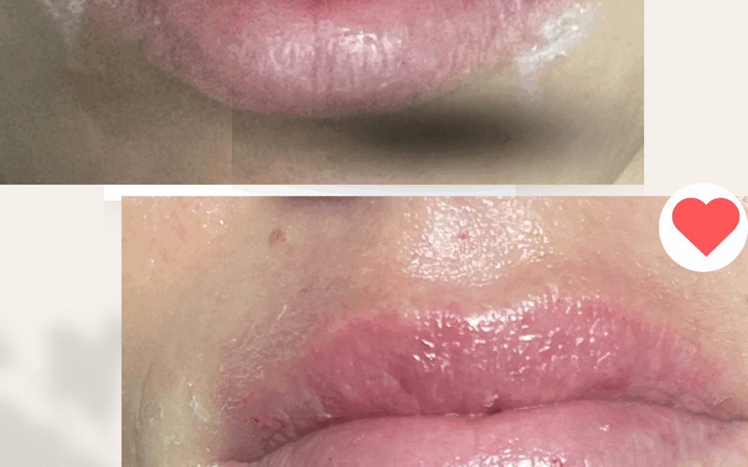 aumento de labios
