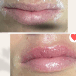 aumento de labios