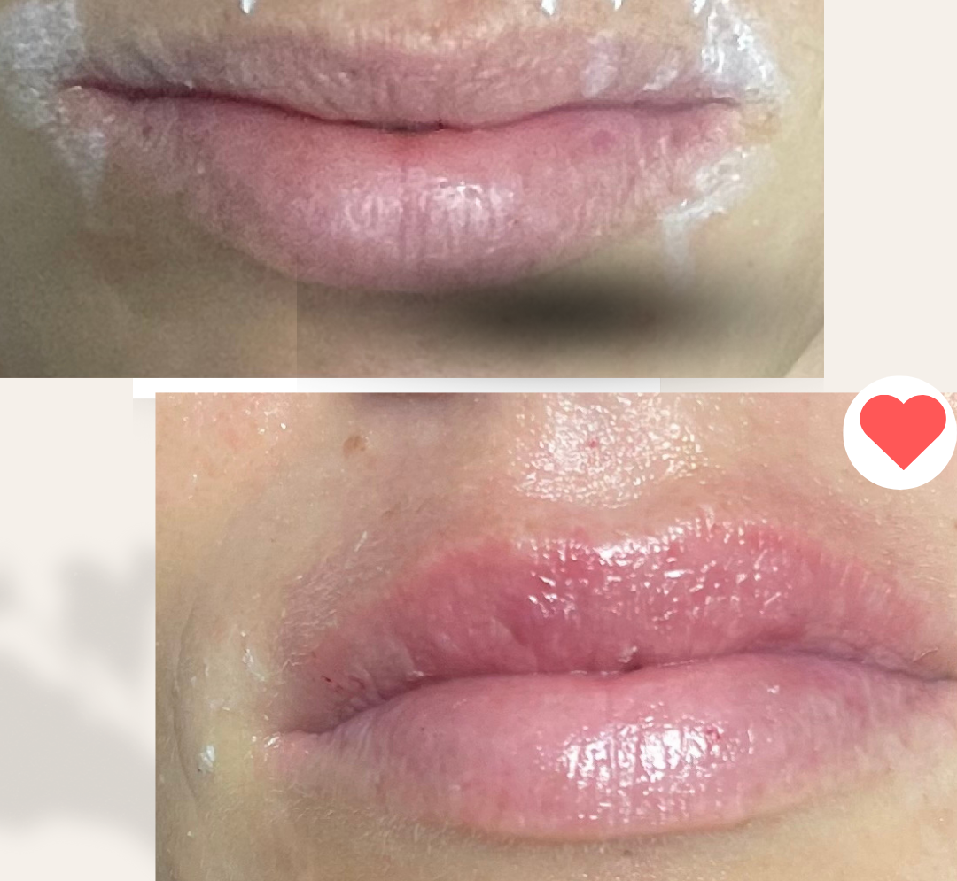 aumento de labios