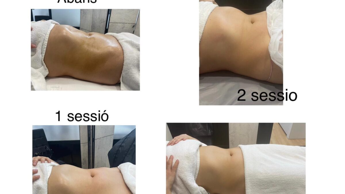 Maderoterapia corporal