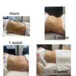 Maderoterapia corporal