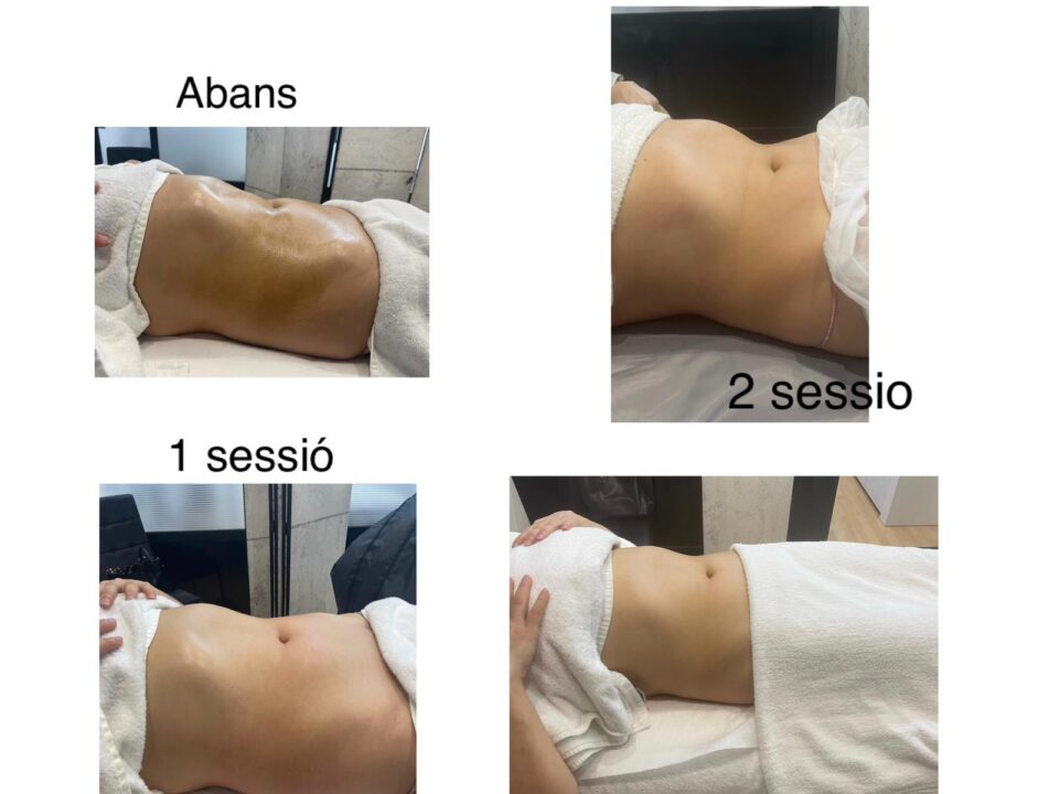 Maderoterapia corporal