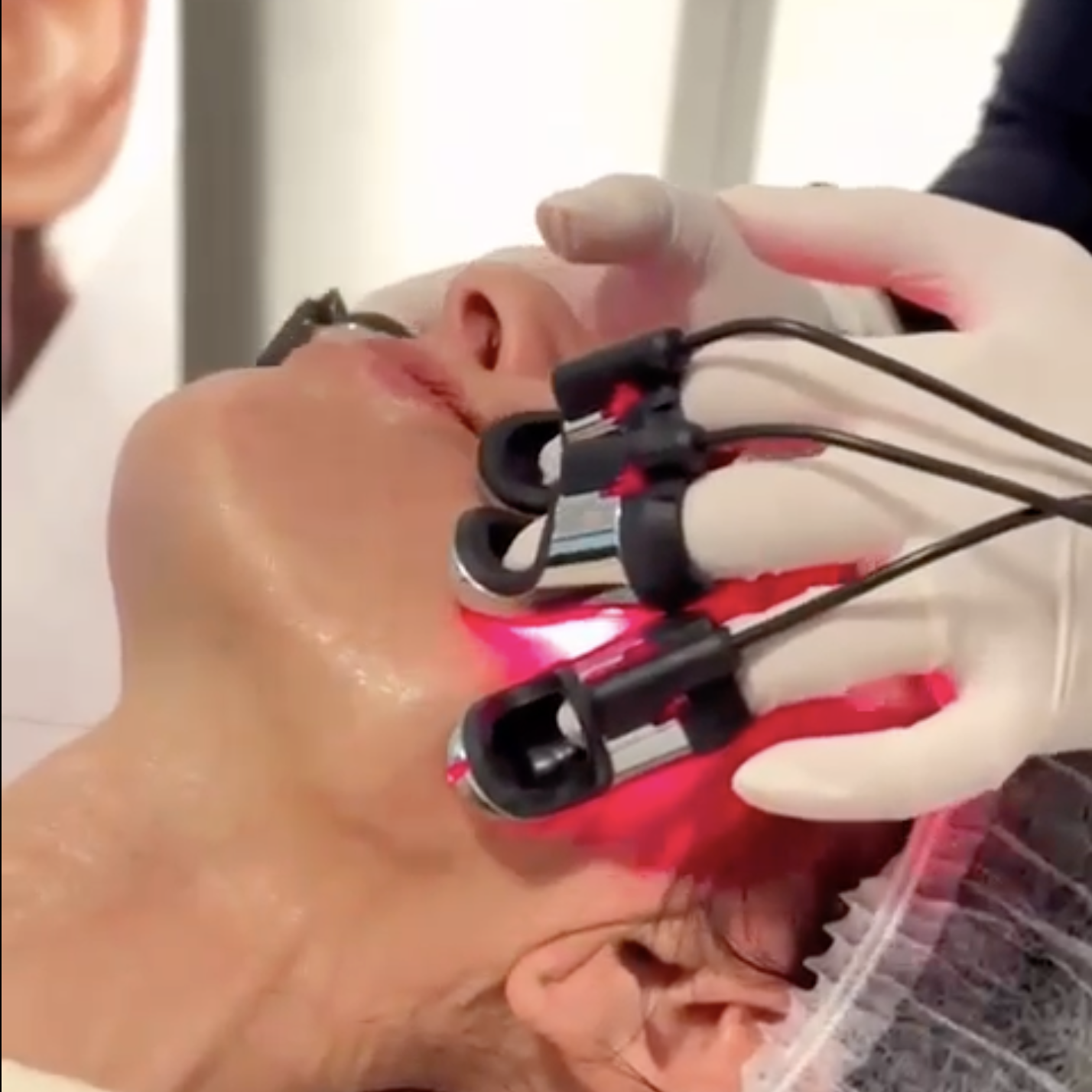 Radiofrecuencia facial y corporal con guantes